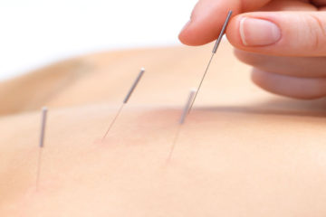 dry-needling-Capalaba-Physio dry needling Capalaba Physio