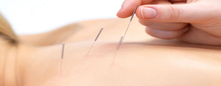 dry needling Capalaba